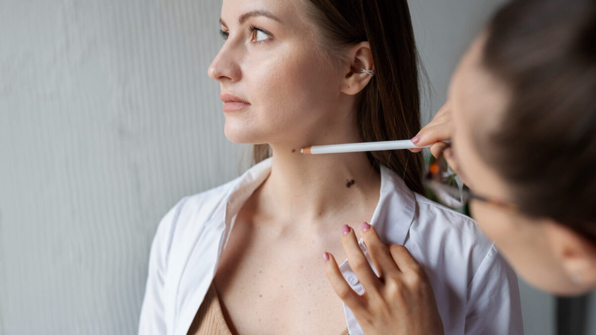 Laserowe usuwanie pieprzyków