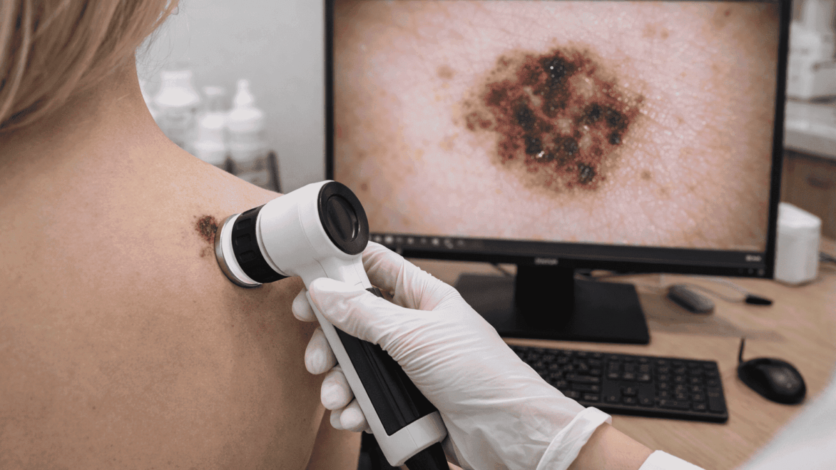 Na czym polega badanie wideodermatoskopia